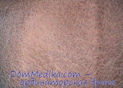 Ихтиоз при онкологическом заболевании