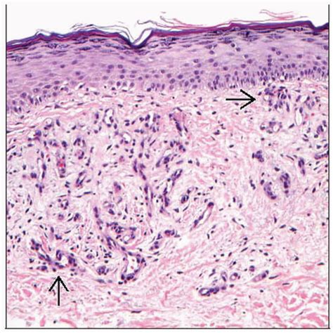 Stasis Dermatitis | Basicmedical Key