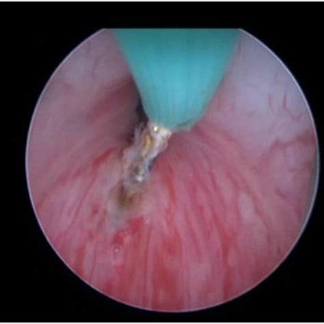 Performing Superficial Bladder Neck Incision With Hook Diathermia