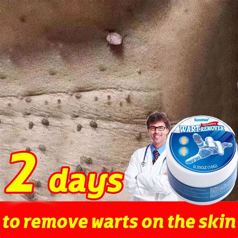 Sumifun Effective Warts Remover Original Warts Magic Remover Wart