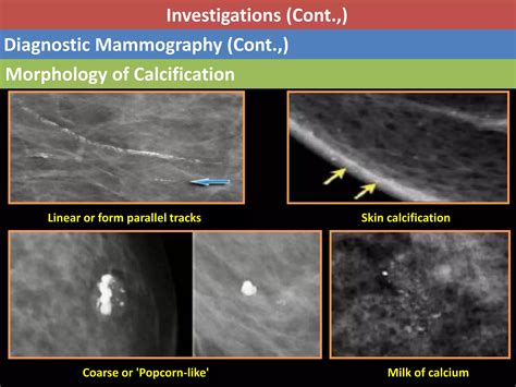 Ductal Carcinoma In Situ Dcis Ppt