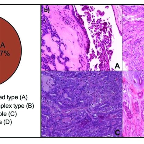 Histological Subtypes Of Malignant Mammary Gland Tumors Analyzed By