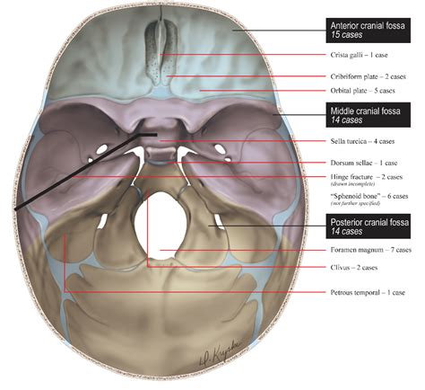 Figure 1 from Skull Base Fractures are Markers of Severe Forces in the ...