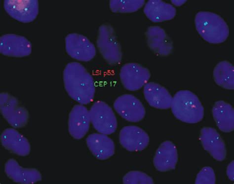 FISH Analysis Using Vysis LSI TP53 SpectrumOrange CEP17 SpectrumGreen