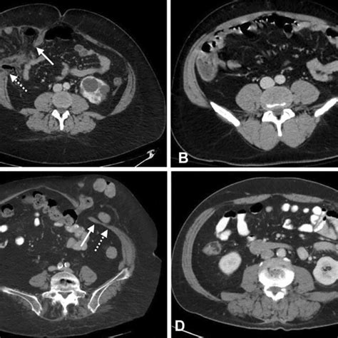 Etep Repair Of Lateral Incisional Hernia After Urologic Procedure A