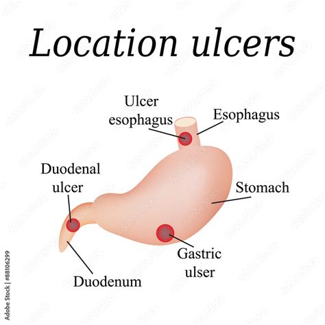 Esophagus ulcer affected. Ulcer of esophagus. Stomach ulcer Stock ...