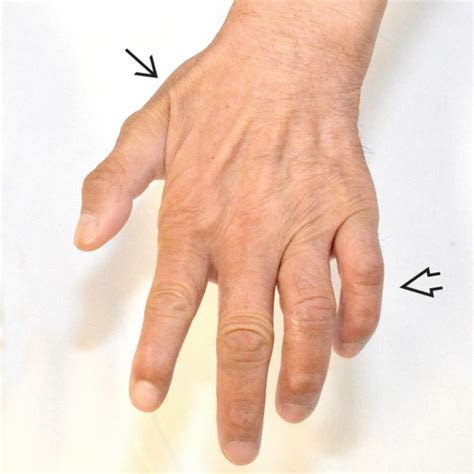 Unbelievable Tips About How To Treat Cubital Tunnel Syndrome Blueleg