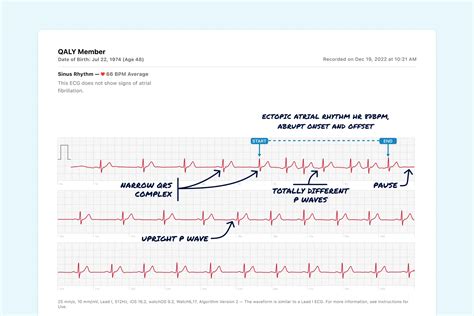 Ectopic Atrial Rhythm Vs. Supraventricular Tachycardia (Non-Sustained ...