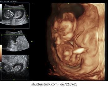 Image Ultrasound D D Baby Mothers Womb Stock Photo Edit Now