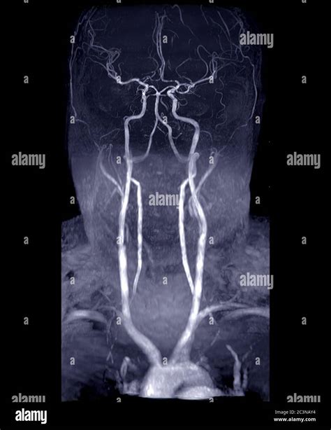 Mra Brain And Neck Or Magnetic Resonance Angiography Mra Of