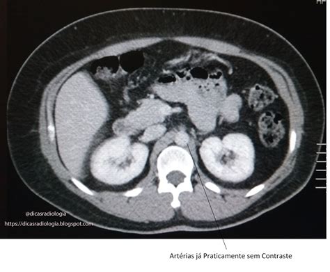 Dicas De Radiologia Tomografia De Abdome Total Fases Do Contraste