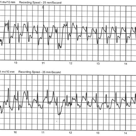 Sinus Tachycardia 160 Bpm With St Segment Depression Consistent With