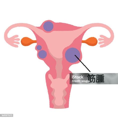 Uterine Fibroid Stock Illustration Download Image Now Healthcare