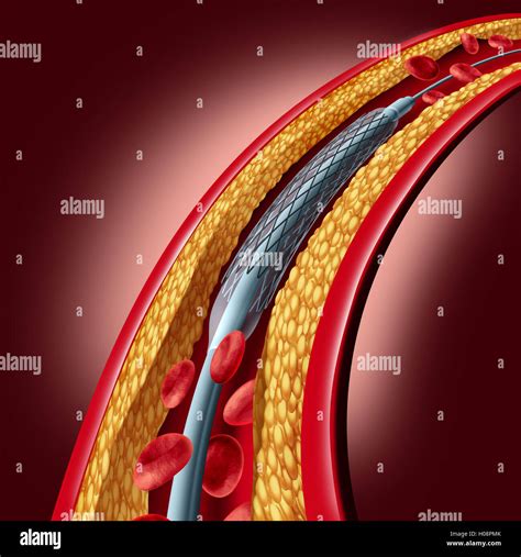 Colocaci N De Un Stent En La Arteria Coronaria Fotograf As E Im Genes