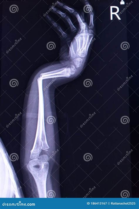 Forearm X Ray Showing Fracture Of Radius And Ulna Stock Photo