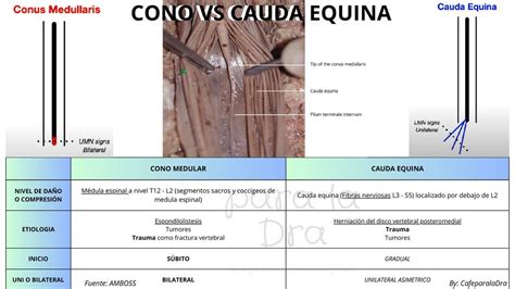 NEUROLOGIA CONO MEDULAR VS SINDROME DE CAUDA EQUINA Dra Baltodano