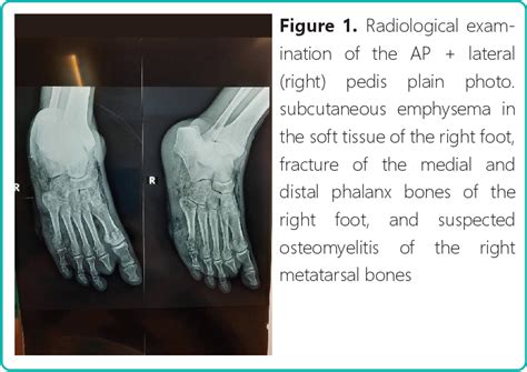 Figure 1 From Diabetic Foot Ulcer Complicated With Fracture And Osteomyelitis X Ray Findings