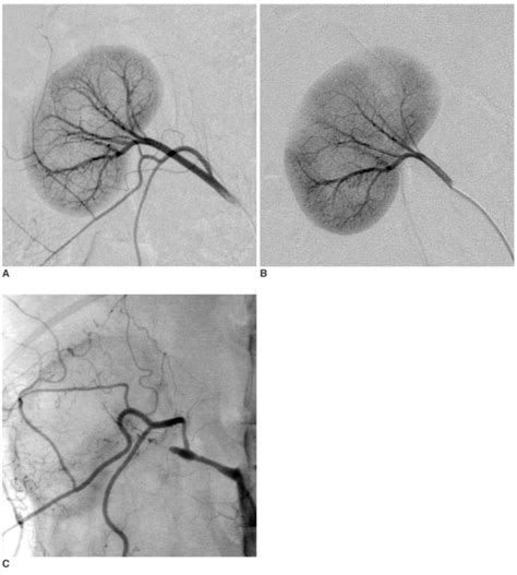 Eem Embolization 03l 326 A Normal Selective Right Renal Arteriogram Download Scientific