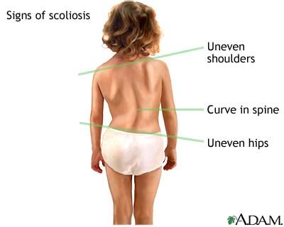 Symptoms of Scoliosis - Hudson Valley Scoliosis