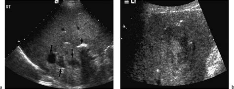 Ultrasound Follow Up Of Liver Transplantation Radiology Key