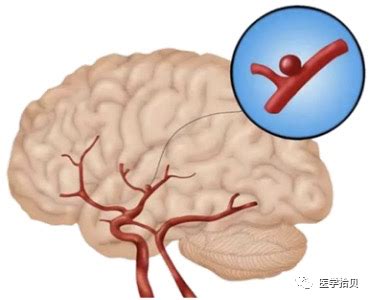 硬核科普丨颅内动脉瘤 动脉瘤 破裂 出血 癫痫 健康界