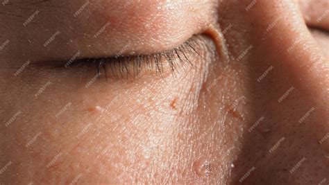 Premium Photo Wart Skin Removal Macro Shot Of Warts Near Eye On Face Papilloma On Skin Around