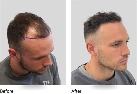 Hair Transplant Sydney Expert Fue Hair Transplant