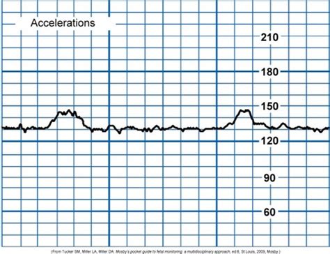Fetal Heart Rate Tracings Flashcards | Quizlet