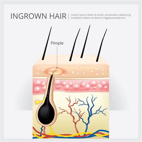 Ingrown Hair Structure Vector Illustration Template Download On Pngtree