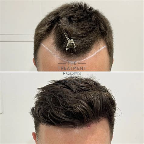 Receding Hairline And Hairline Transplant Treatment Rooms London