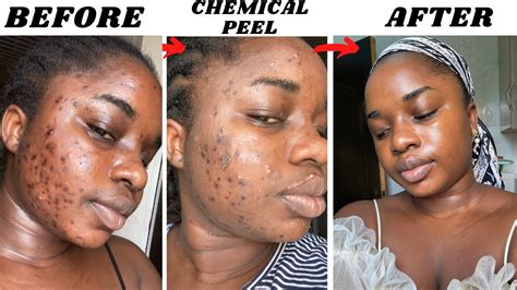 My Acne Journey How I Cleared My Acne Chemical Peel Pictures Included Youtube