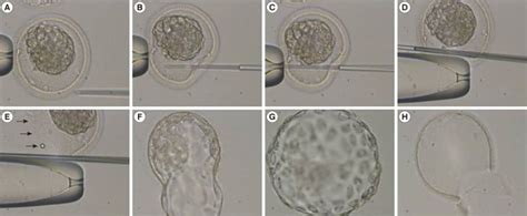 Long Zona Dissection Using Icsi Pipettes Just After Thawing A Hold A