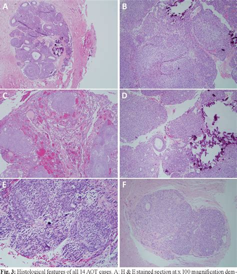 Figure 2 From Adenomatoid Odontogenic Tumor Case Series Of 14 With