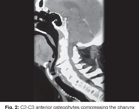 Figure 1 From Dysphagia Caused By Anterior Cervical Osteophytes At C2 C3 Unusual Location And