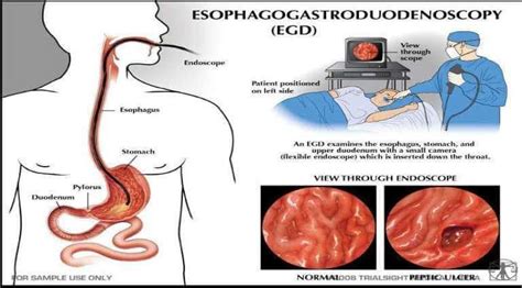 Lower Endoscopy Procedure