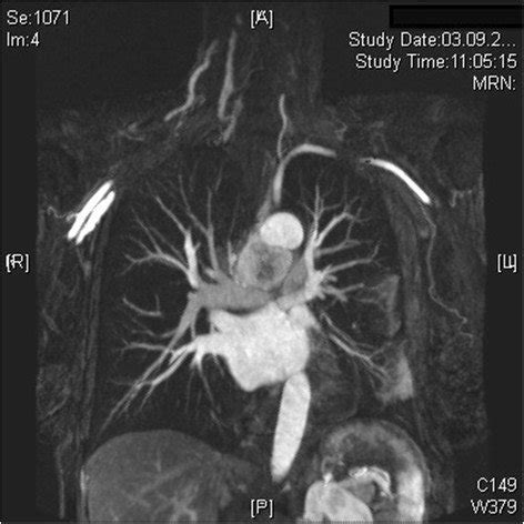 Preoperative Magnetic Resonance Scan Of Patient Paraganglioma Of The