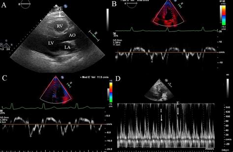 Effusiveconstrictive Pericarditis In The Spectrum Of Pericardial