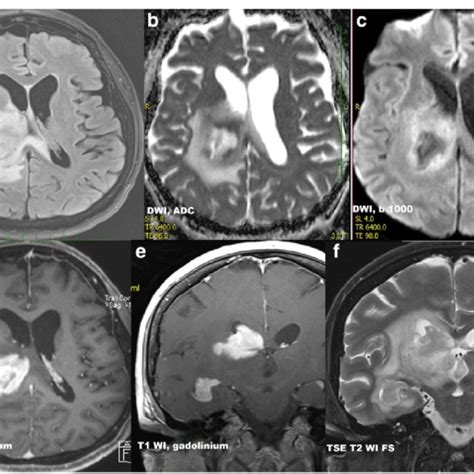 A FLAIR Axial Scan B DWI ADC Map Axial Scan C DWI B 1000 Axial