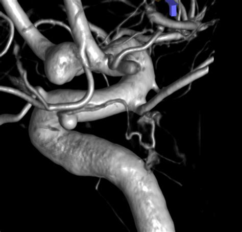 Superior Hypophyseal Artery