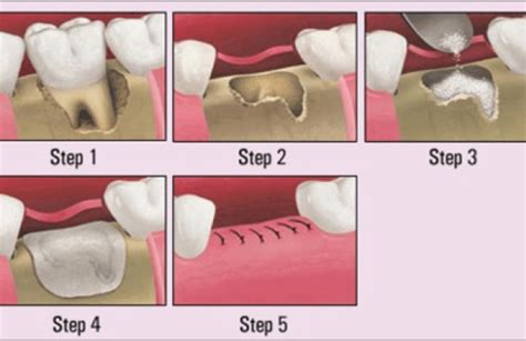 Bone Graft Oaks Dental Korea