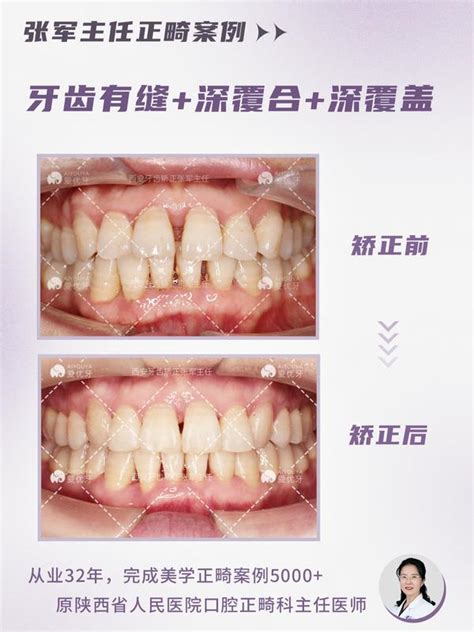 西安牙齿矫正：磨牙远移的同时关闭牙齿间隙 知乎