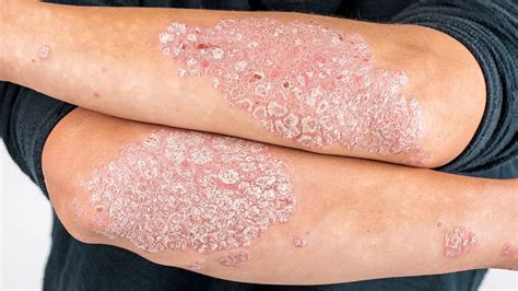 Eczema Uzm Dr Seher Arı