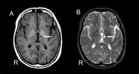 Stroke, lacunar; Infarction, Lacunar