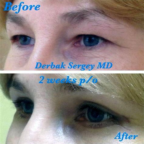 2 Weeks After Laser Eyelid Surgery » Eyelid Surgery: Cost, Photos, Rewiews, Q&A