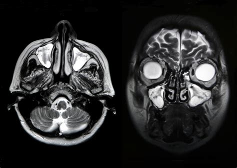 Scanner Des Sinus R Le Et D Roulement De L Examen Ooreka