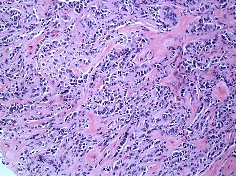 Invasive Ductal Carcinoma Histology