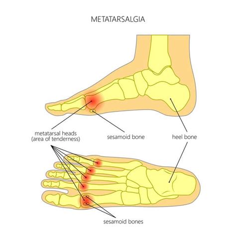 Forefoot Pain - Soul Insole | Painful Foot Disorders