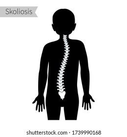 Spinal Deformity Types White Spine On Stock Vector Royalty Free