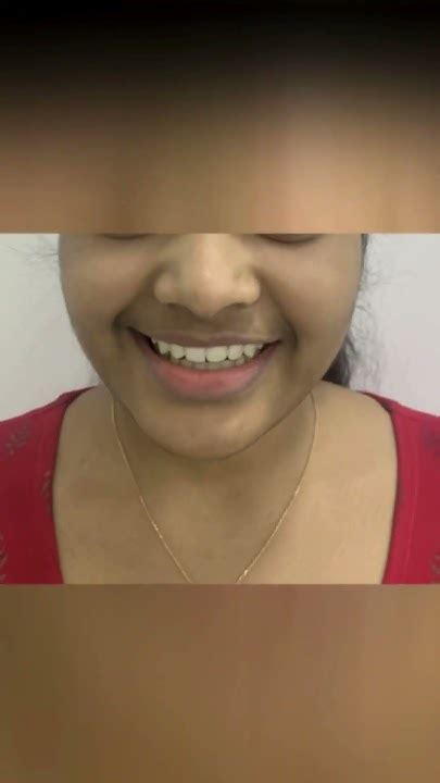 Teeth Gaps Treatment Invisalign Aligners Treatment Hyderabad