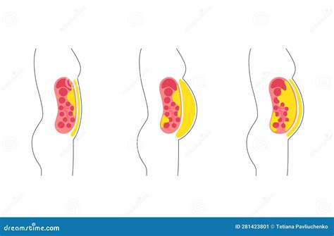 Visceral Fat Diagram Stock Vector Illustration Of Subcutaneous 281423801